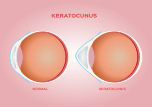 Illustration showing two cross-sections: one of a healthy eye and one with keratoconus