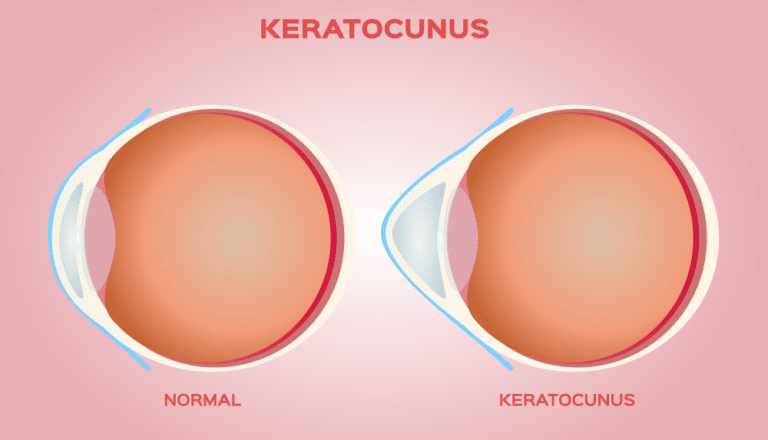 Illustration showing two cross-sections: one of a healthy eye and one with keratoconus